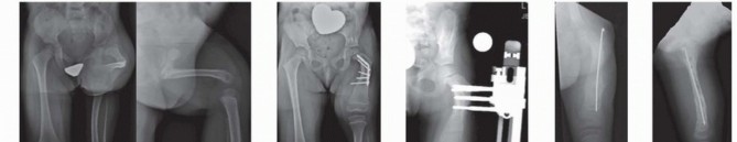 Illustration 33 for Treatment for Congenital Femoral Deficiency: What You Need to Know