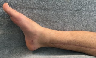 Illustration 26 for Complex Tibial Shaft Fracture: Plate Fixation for Plafond Extension