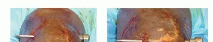 تيبس الركبة (فقدان نطاق الحركة): دليل المريض الشامل للتشخيص والعلاج والتعافي