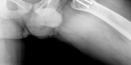 Illustration 11 for Conservative Head Reduction Osteotomy: Restoring Young Hip Function
