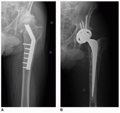 Illustration 7 for Overcoming Proximal Femoral Deformity in THA: Key Strategies