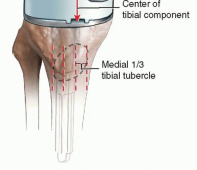 Illustration 21 for Correcting Stiffness in Revision TKA: Achieve Appropriate External Rotation