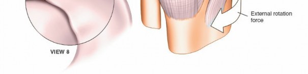 Illustration 20 for Mastering Knee Approaches: Spotlight on Superficial Medial Ligament