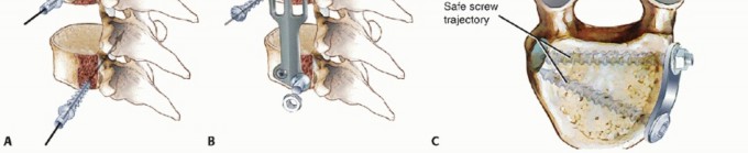 Illustration 8 for Anterior Thoracic Corpectomy: Decompression, Stabilization, Fusion