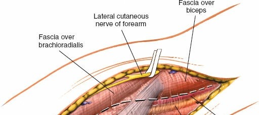 Illustration 78 for Mastering Elbow Approaches: Applied Surgical Anatomy for Precision
