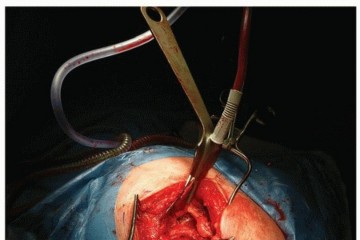 Illustration 18 for Cemented Acetabular Component: Achieving Optimal THA Stability