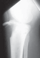 Mastering Open Reduction & Internal Fixation of Tibial Tuberosity Fractures