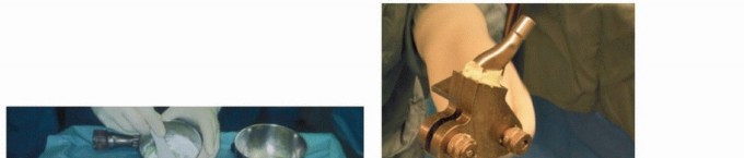 Illustration 3 for PJI of the Hip: Two-Stage Revision: When & How to Prepare