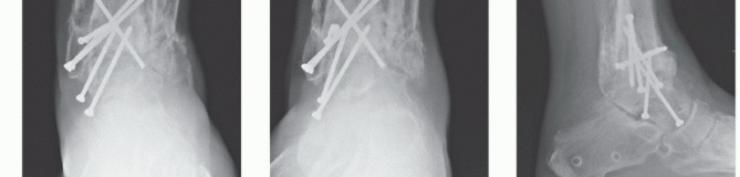 Illustration 34 for Optimize Pain Management with Proximal Ring Block for Ankle Arthrodesis