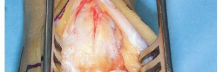 Illustration 9 for HINTEGRA Total Ankle: Unlocking Natural Ankle Movement