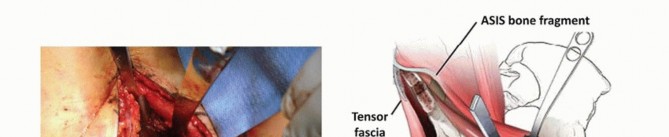 Illustration 15 for Restore Hip Health: Pelvic Osteotomy for Acetabular Dysplasia & CEA of Less