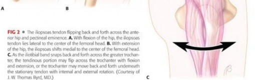 Illustration 22 for Stop the Snap: Hip Preservation for Snapping Iliopsoas Tendon