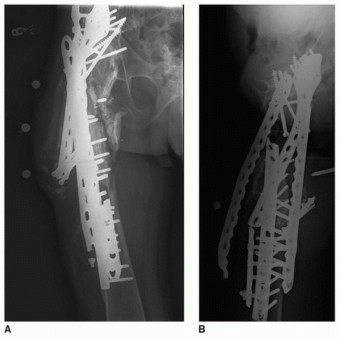 Illustration 41 for Allograft Prosthetic Composite: Mastering Proximal Femur Reconstruction
