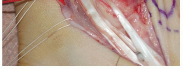 Illustration 7 for Beyond Primary Repair: Solutions for Peroneal Tendon Subluxation