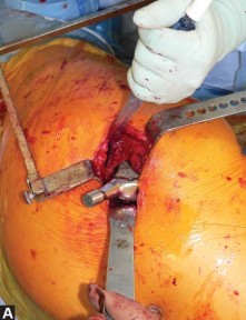 Illustration 55 for Exploring the Ambulatory Surgical Setting for Total Hip Replacement