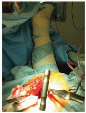 Illustration 12 for Why Polished Tapered Cemented Stems Excel in Hip Replacement