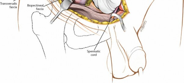 Illustration 72 for Pelvis & Acetabulum Approaches: Unlocking the Posterior Superior Iliac