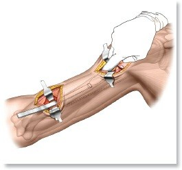 Illustration of approach to the shoulder - Dr. Mohammed Hutaif