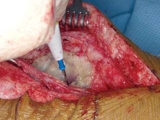 Illustration 20 for PROSTALAC Articulating Spacer: Treat Infected Knees, Regain Mobility