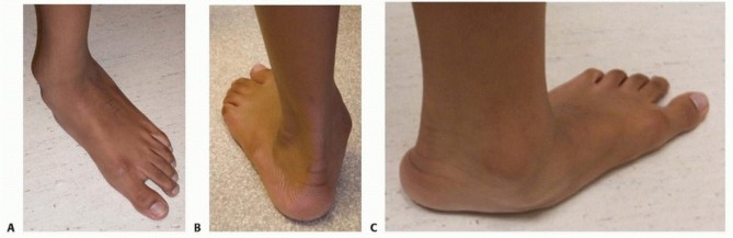 Calcaneal Lengthening Osteotomy: Correcting Hindfoot Valgus