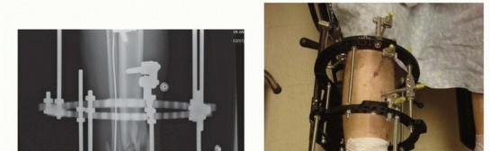 Illustration 5 for Tibia External Fixation: See How Pins Are Placed for Healing