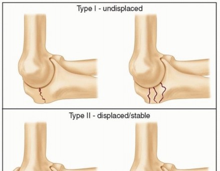 Proximal Ulna: Optimal Internal Fixation of Fractures