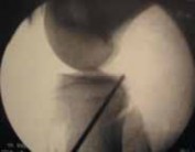 Illustration 10 for Cruciate Ligament Repair: Definitive Guide to Treatment & Recovery