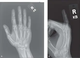 صورة توضيحية لـ كسر عنق المشط الخامس (كسر الملاكم): دليل شامل للعلاج والتعافي مع الأستاذ الدكتور محمد هطيف