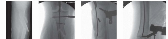 Illustration 29 for Optimizing Intramedullary Nailing for Tibial Shaft Fractures