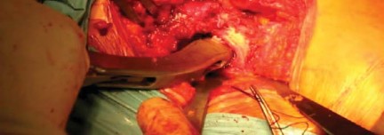 Illustration 22 for The Proxima: Why This Proximally Loading Implant Preserves Bone