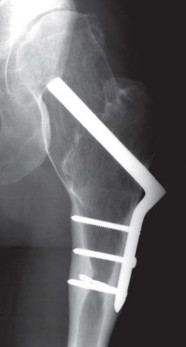 Illustration 114 for Successful Total Hip Replacement in Developmental Dysplasia