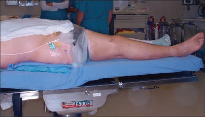 Illustration 14 for PROSTALAC Articulating Spacer: Treat Infected Knees, Regain Mobility