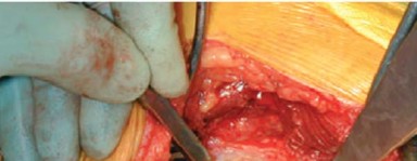 Illustration 24 for Optimizing Acetabular Component Cementation for Superior Outcomes