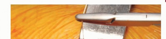 Illustration 38 for Anterior FAI Relief: Mini-Open Anterior Approach Explained