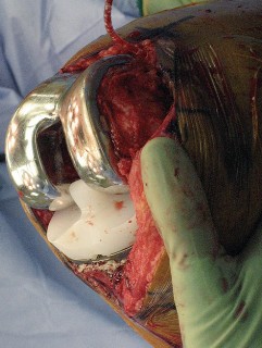 Illustration 53 for Posterior Stabilized Technique: Essential Insights for TKA Success