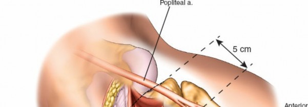 Figure 15: Placement of a pre-contoured posterolateral locking plate.