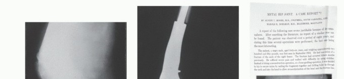 Distal Femoral Replacement: Key to Modern Limb Salvage