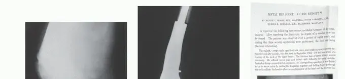 استبدال عظم الفخذ البعيد: مفتاح إنقاذ الأطراف الحديث في جراحة الأورام العظمية