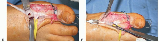 Illustration 29 for How Achilles Tendon Lengthening Fixes Equinocavovarus Foot
