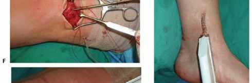 Illustration 34 for Painful Talus Lesions? The tech fig c Osteochondral Transfer Solution