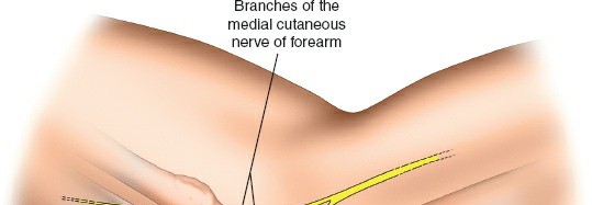 Illustration 84 for Mastering the Approach to the Distal Humerus: Safety & Skills