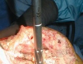 Illustration 9 for Porous Metal Cones: Biologic Fixation for Severe Bone Loss