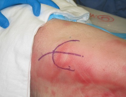 Minimally Invasive THA: Navigating Techniques, Benefits & Pitfalls