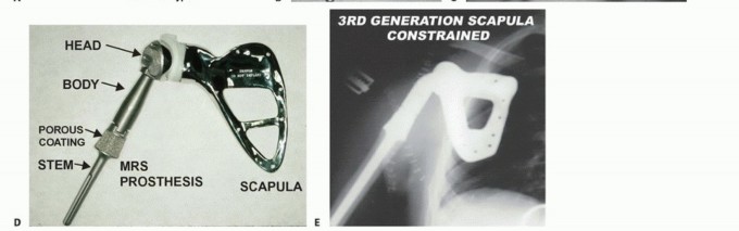 Illustration 36 for Limb-Sparing Resections Around the Shoulder: Optimizing Outcomes