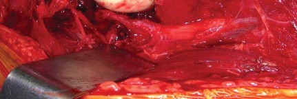 Illustration 39 for Navigating Early THA for Fractures of the Acetabulum