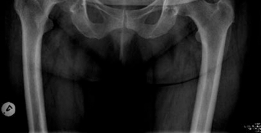 Illustration 2 for Achieving Success with Uncemented Hip Arthroplasty Metal Socket