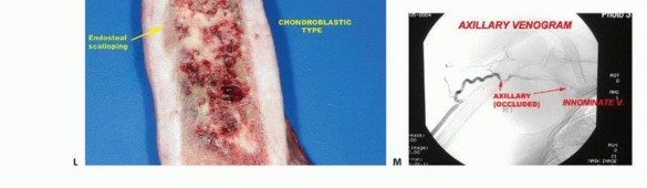 Illustration 24 for Understanding Benign Bone Tumors: Your Complete Preoperative Guide