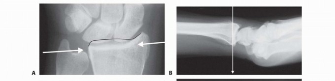 Illustration 10 for Fragment-Specific Fixation: Restore Carpal Facet Horizon