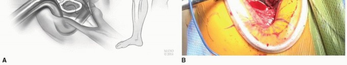 صورة طبية: النهج الأمامي لاستبدال مفصل الورك الكلي: ثورة في جراحة الورك مع الأستاذ الدكتور محمد هطيف في صنعاء