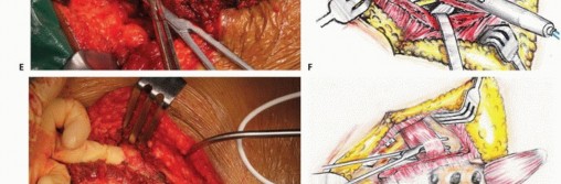 Illustration 34 for Sacral Tumor Surgery: Safeguarding Bowel & Bladder Control